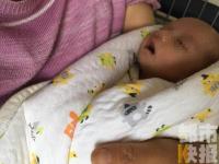 陕西孕妇产下罕见胎中胎 男婴腹中